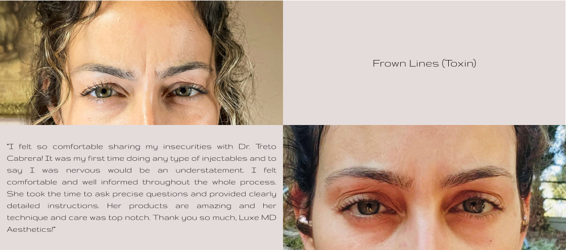 Frown Lines (Toxin) “I felt so comfortable sharing my insecurities with Dr. Treto Cabrera! It was my first time doing any type of injectables and to say I was nervous would be an understatement. I felt comfortable and well informed throughout the whole process. She took the time to ask precise questions and provided clearly detailed instructions. Her products are amazing and her technique and care was top notch. Thank you so much, Luxe MD Aesthetics!”