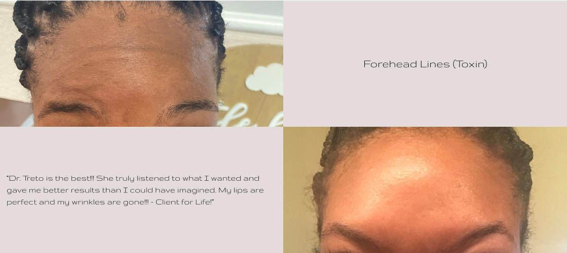 Forehead Lines (Toxin) “Dr. Treto is the best!!! She truly listened to what I wanted and gave me better results than I could have imagined. My lips are perfect and my wrinkles are gone!!! - Client for Life!”