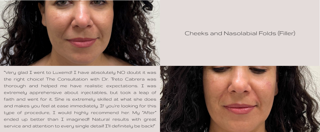 Cheeks and Nasolabial Folds (Filler) “Very glad I went to Luxemd! I have absolutely NO doubt it was the right choice! The Consultation with Dr. Treto Cabrera was thorough and helped me have realistic expectations. I was extremely apprehensive about injectables, but took a leap of faith and went for it. She is extremely skilled at what she does and makes you feel at ease immediately. If you're looking for this type of procedure, I would highly recommend her. My “After” ended up better than I imagined!! Natural results with great service and attention to every single detail! I’ll definitely be back!”