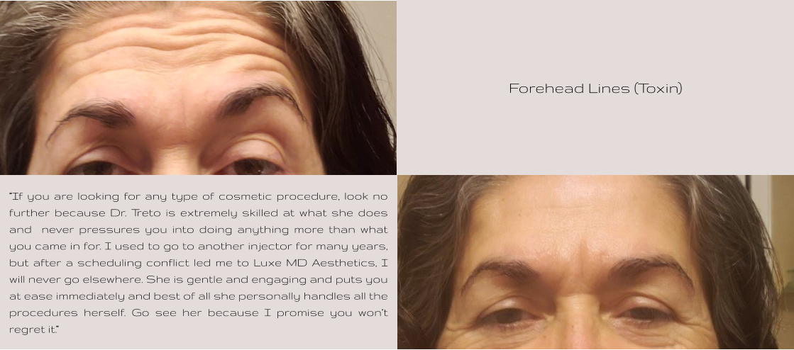 Forehead Lines (Toxin) “If you are looking for any type of cosmetic procedure, look no further because Dr. Treto is extremely skilled at what she does and  never pressures you into doing anything more than what you came in for. I used to go to another injector for many years, but after a scheduling conflict led me to Luxe MD Aesthetics, I will never go elsewhere. She is gentle and engaging and puts you at ease immediately and best of all she personally handles all the procedures herself. Go see her because I promise you won’t regret it.”