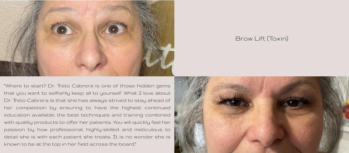 Brow Lift (Toxin) “Where to start? Dr. Treto Cabrera is one of those hidden gems that you want to selfishly keep all to yourself. What I love about Dr. Treto Cabrera is that she has always strived to stay ahead of her competition by ensuring to have the highest continued education available, the best techniques and training combined with quality products to offer her patients. You will quickly feel her passion by how professional, highly-skilled and meticulous to detail she is with each patient she treats. It is no wonder she is known to be at the top in her field across the board.”