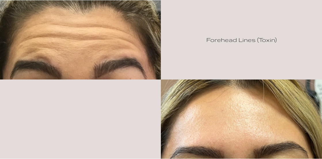 Forehead Lines (Toxin)